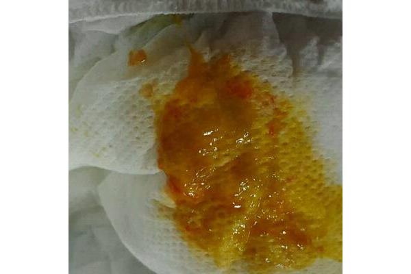 婴儿大便有粘液