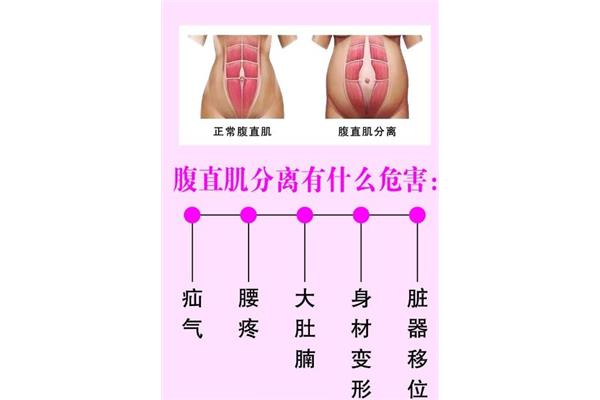 什么是腹直肌分离