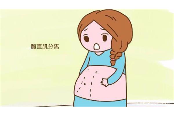 什么是腹直肌分离