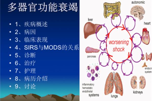 多器官功能衰竭