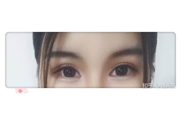 上眼皮抽脂