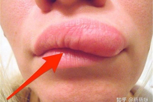 嘴唇痒是怎么回事