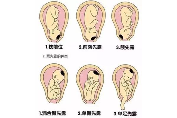 胎位不正怎么办