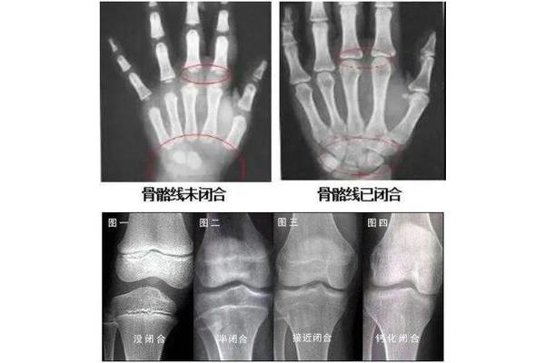 女生骨骼闭合年龄