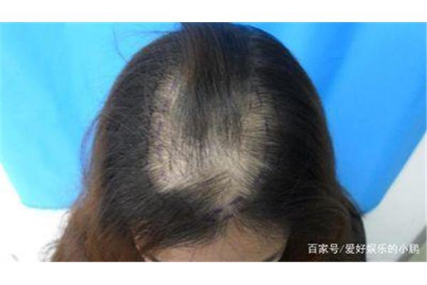 鬼剃头怎么治疗