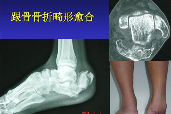 骨折愈合标准