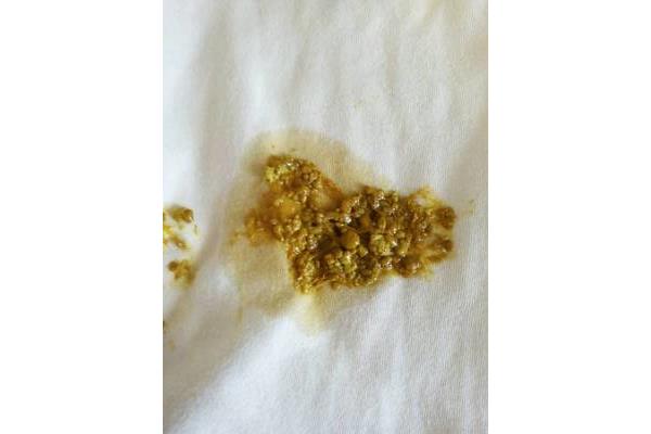 新生儿一天没大便