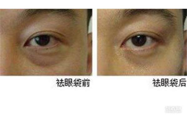 眼袋有皱纹怎么办