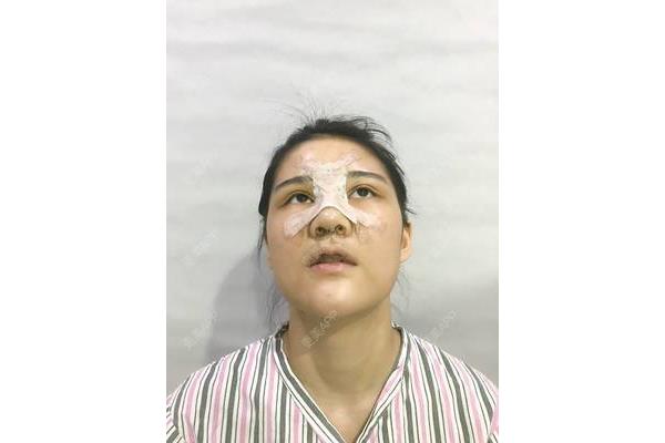 小孩流鼻血怎么办