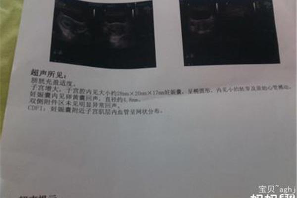 卵黄囊是什么意思