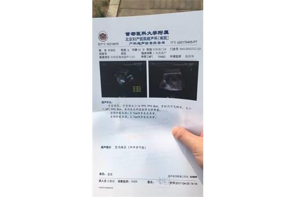 卵黄囊是什么意思