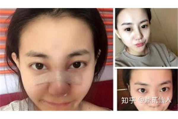 脸消肿的最快方法