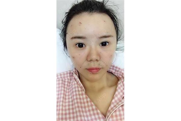 脸消肿的最快方法