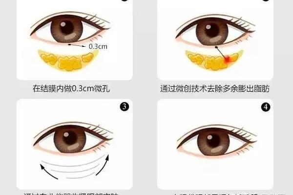 眼袋重怎么消除