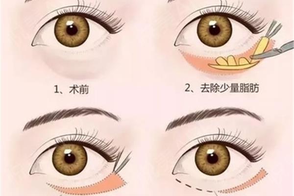 眼袋重怎么消除