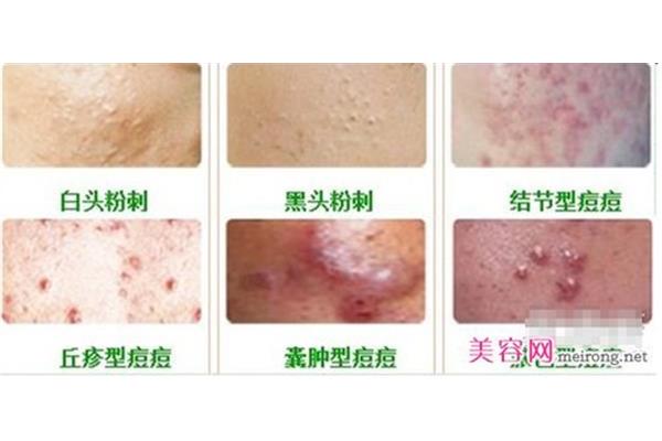 结节囊肿型痘痘
