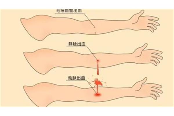 止血方法有哪几种