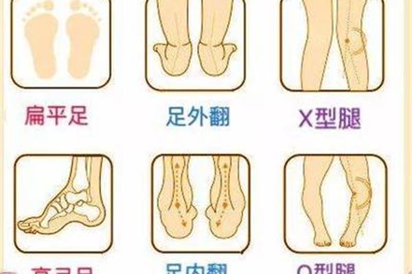 足外翻怎么治疗